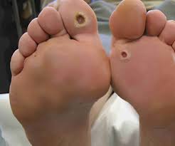 We did not find results for: Diabetes Foot Care Treatment Prevention