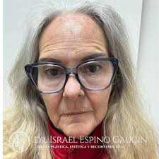 EleganceInEveryStage One of the most important aspects of facial  rejuvenation is seeing the real progress in the early days. Today, I had  the pleasure of seeing my 65-year-old patient