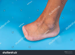 Image result for toe amputation