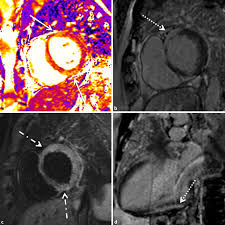 Findings were consistent with giant cell myocarditis. Cardiac Mri Update 2020 Springerlink