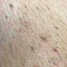 Ingrown hairs are common effects of waxing and shaving. Pin On The Wax Den