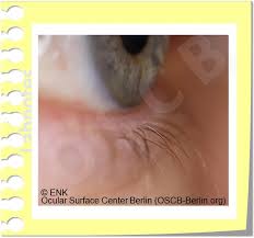 Bernama 1 mempunyai atau memakai nama: Glimpse On The Lid Margin Ocular Surface Center Berlin