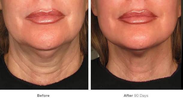 Tratamiento Ultherapy Prime en Coruña - Estética Kerala