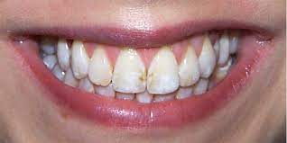 Fluoroseflecken Auf Den Zahnen Behandeln Dentalmagazin De