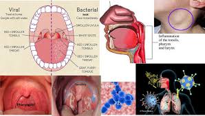 Image result for Pharyngitis