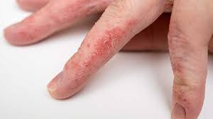 You may be diagnosed by a general healthcare provider or a dermatologist. Eczema Atopic Dermatitis Types Causes Treatment And More