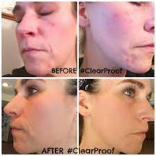 Mary Kay Clear Proof Acne System Review Clearproof A Little Goes A Long Way Check It Out Mary Kay Clearproof Mary Kay Mary Kay Business