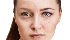 Nel caso della sindrome di sjogren queste reazioni si manifestano con un'infiammazione a carattere cronico che finisce per distruggere le ghiandole esocrine ossia tutte quelle che riversano le loro secrezioni esternamente al corpo. Lupus Eritematoso Sistemico Les Patologie Alomar Onlus Associazione Lombarda Malati Reumatici