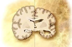 It is a form of dementia. Viren Als Ausloser Von Alzheimer Herpeserreger Konnten Am Entstehen Und Fortschreiten Der Demenz Beteiligt Sein Scinexx De
