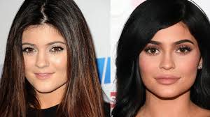 We cover images of kylie jenner before surgery alongwith the changes in kylie skin. Kylie Jenner Before And After Surgery Yve Style Com