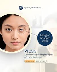 👨‍⚕️ Dr. Ramon Henry F. Dickson, MD, MHA, DPBO breaks down the myths vs.  facts about cataracts! 🕶✨ Don't let misconceptions blur your vision—know  the truth and protect your eyes. 📍 2F