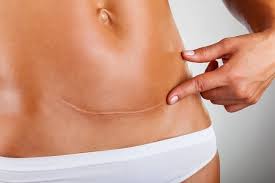 Como Quitar Una Cicatriz A Traves De Una Cirugia Plastica Tua Saude
