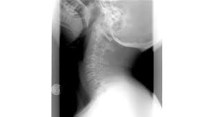 Check spelling or type a new query. El Mareo De Origen Cervical Sintomas Causas Y Tratamiento