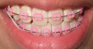 Gallery For Clear Braces Colored Bands Pink Braces Braces Colors Clear Braces