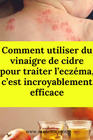 Pin On Peau Seche