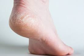 Flip Flop Weather Means Dry Thickened And Cracked Skin On My Feet Any Preventatives The Dermatology Specialists