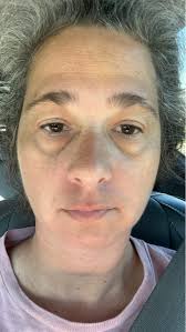 What are allergy shiners under eyes?