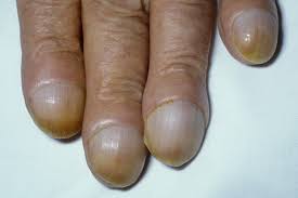 When chronic kidney disease reaches an advanced stage, dangerous levels of fluid. Nail Disorders Clinical Advisor