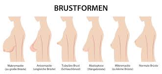 Nicht alle brustwarzen stehen ab; Brustfehlbildung Ursachen Formen Beschwerden Therapie
