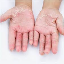 Image result for contact dermatitis