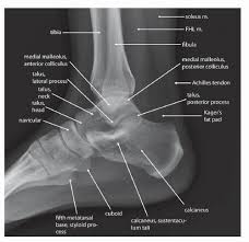 Image result for Ankle XRay