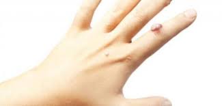 خلطات منزلية لعلاج الثالول المرأة والصحة الصباح العربي