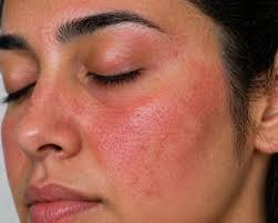 संवेदनशील त्वचा और लालिमा के लिए सौम्य देखभाल