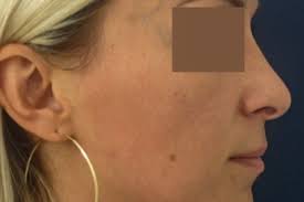 Beläget precis mitt i ansiktet är längden, formen och bredden på näsan verkligen viktig och kan. Plastische Operation Der Nase Beziehungsweise Rhinoplastik Klinik Esthe Prag