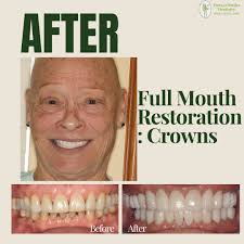 Check out Vicki's gorgeous smile after Crowns here at Terrace Smiles! Call  us at (813)977-7000 to schedule your appointment! See her testimonial,  before and afters of other guests, and more