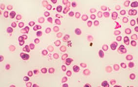 Image result for Striga baumannii