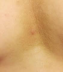 Manchas Marrones En Los Senos Que No Son Hongos Dermatologo Net