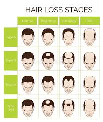 Hair Loss Stages And Types For Men Stock Vector