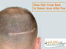 Post Fue Does Hair Grow Back In Donor Area Hair Sure