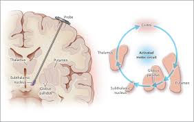 Image result for Thalamic Stimulation
