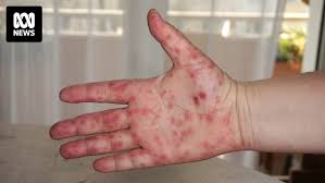 Image result for Hand foot and mouth disease HFMD roof of mouth