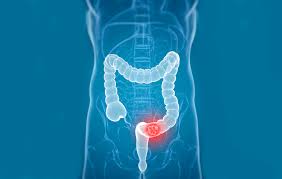 A persistent change in your bowel habits, including diarrhea or constipation or a change in the consistency of your stool rectal bleeding or blood in your stool persistent abdominal discomfort, such as cramps, gas or pain Colorectal Cancer Know Your Risks Get Tested Altamed