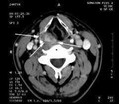 Ct (or cat) stands for computed (axial) tomography. Ct Scan Of The Neck Using Contrast Dye Revealed A Tumor 1 5 Cm In Download Scientific Diagram