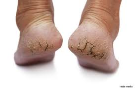 Cracked Heels Kew Foot Clinic