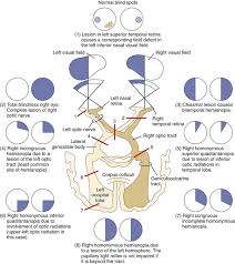 Image result for Visual Field Deficit