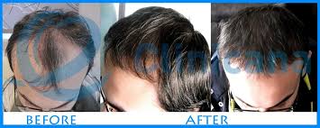 Clinicana Hair Transplant Esthetic Center In Turkey Best Hair Transplant Fue Hair Transplant Hair Transplant