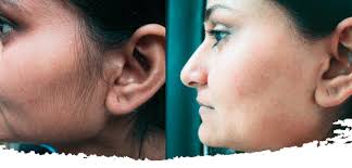 Laser Hair Removal - Tecumseh Laser Centre