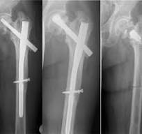 The PFNA® Augmented in Revision Surgery of Proximal Femur ...