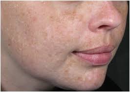 Energy-based devices for the treatment of Acne Scars: 2022 International  consensus recommendations