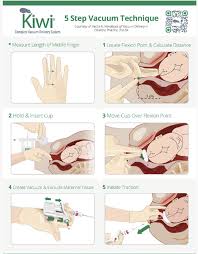 Image result for Vacuum Caput