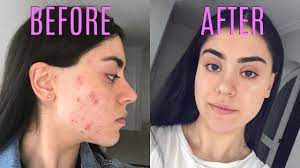 Acne is a skin condition that affects the oil glands and hair follicles, which are connected to the surface of the skin. How I Cleared My Hormonal Acne In 30 Days Youtube