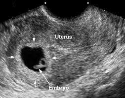 Tragically Wrong When Good Early Pregnancies Are Misdiagnosed As Bad Commonhealth
