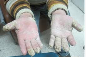Image result for scabies norvegica