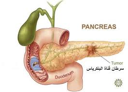 Check spelling or type a new query. Ù…Ø§Ù‚Ù„ ÙˆØ¯Ù„ Ø¹Ù† Ø³Ø±Ø·Ø§Ù† Ø¯ Ù…ÙŠ Ø±Ù…Ø²ÙŠ Ø§Ù„Ø§Ø±Ù†Ø§Ø¤ÙˆØ· Dr M Arnaot Facebook