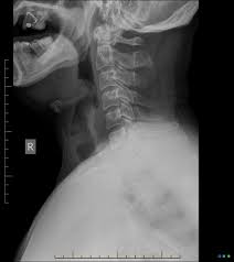 Image result for Epiglottitis