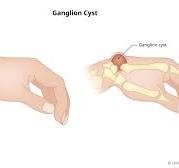 Ganglion Cysts (Wrists, Finger, Foot, Ankle) - Causes ...